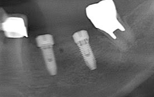 implant01_04_after