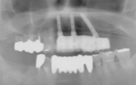 implant02_02_after