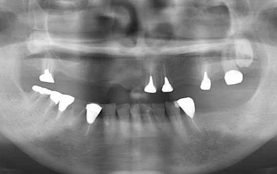implant04_02_before
